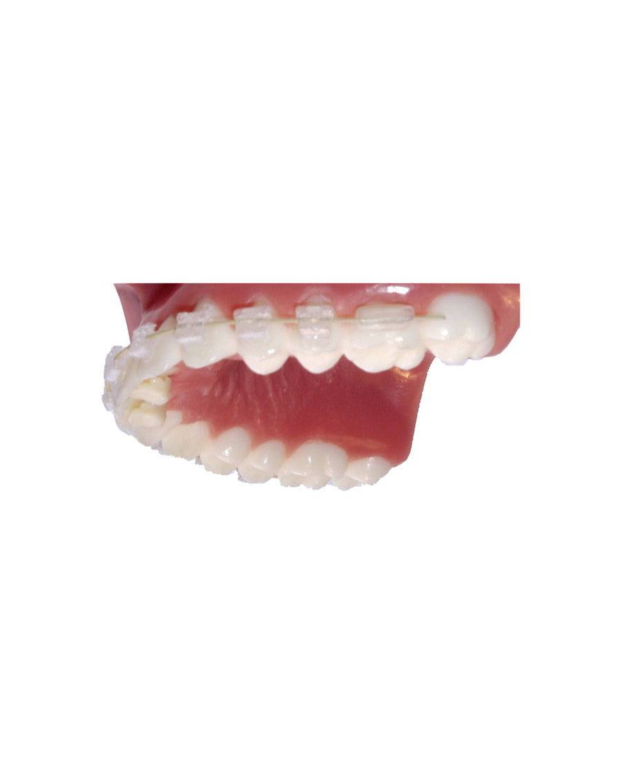 Bite Bumper™ – Ansicht 1